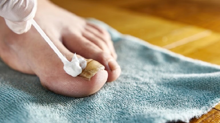 Ayak Tırnak Mantarı Nasıl Geçer? En İyi İlaç Hangisidir?