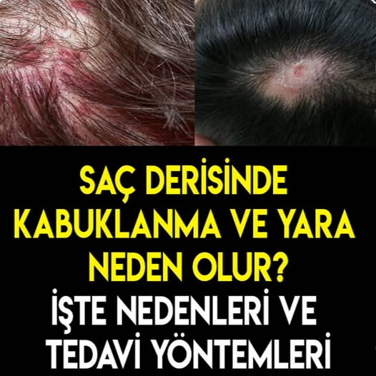 Saç Derisinde Kabuklanma ve Yaralar Neden Olur?