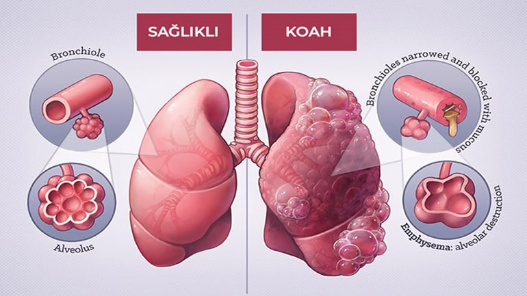 KOAH nedir