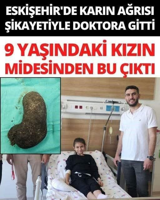 Kızın Midesinden Devasa Saç Yumağı Çıkarıldı