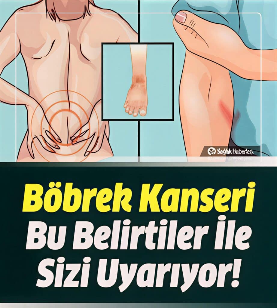 Böbrek Kanseri belirti