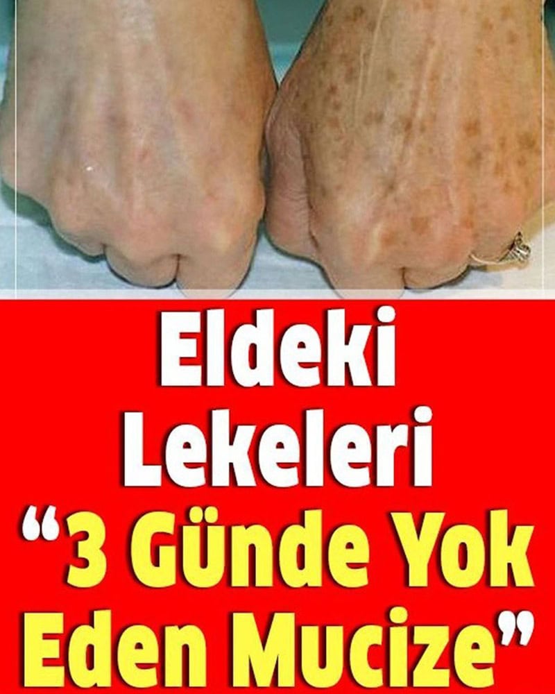 Ellerdeki Cilt Lekelerine