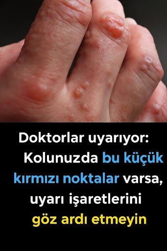 Uyuz Salgını ve Korunma Yöntemleri